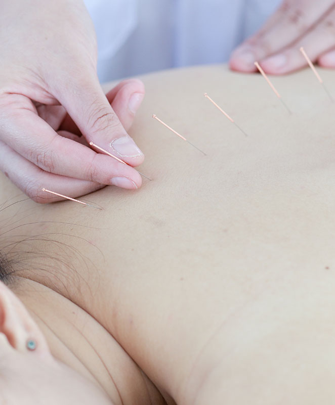 Dry Needling Therapy